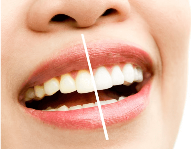 Albirea dentară cu laser. Cum se face, cât durează și de ce este recomandată de medicii dentisti