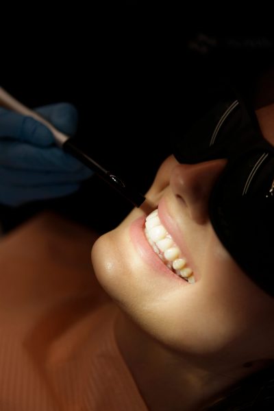 Monza Dental_albire dentara profesionala laser